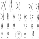 This karyotype shows the complete set of chromosomes in a human female with trisomy 21. There are 47 chromosomes, which appear as dark banded structures against a white background. The chromosomes are organized by chromosome number, and the three copies of chromosome 21 are circled.
